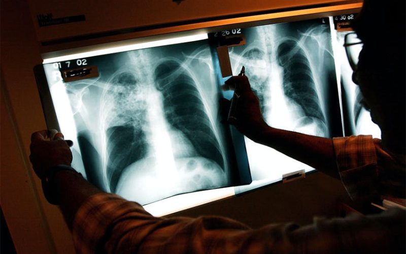 First ever national survey shows the extent of South Africa’s TB problem