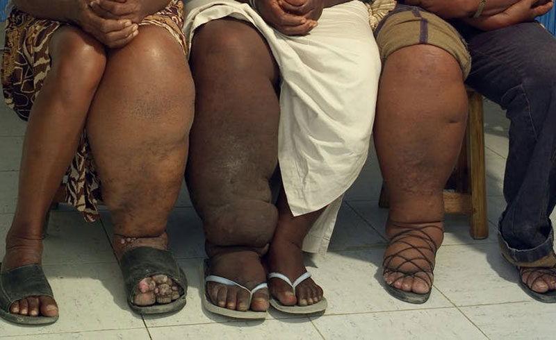 Why it’s hard to end elephantiasis, a debilitating disease spread by mosquitoes