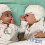 Formerly-siamese-Israeli-twins
