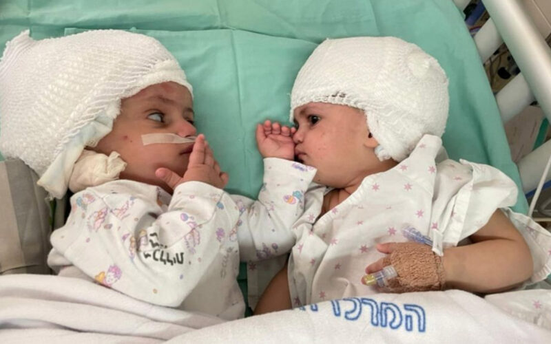 Born conjoined back-to-back, Israeli twins finally see each other after surgery