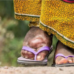 person-with-lymphatic-filariasis