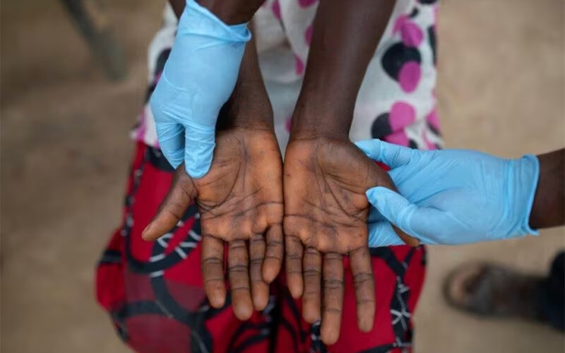 Stigma, regulatory barriers delay mpox response in country that needs it most