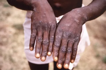 South Africa records first mpox death after five cases in past month