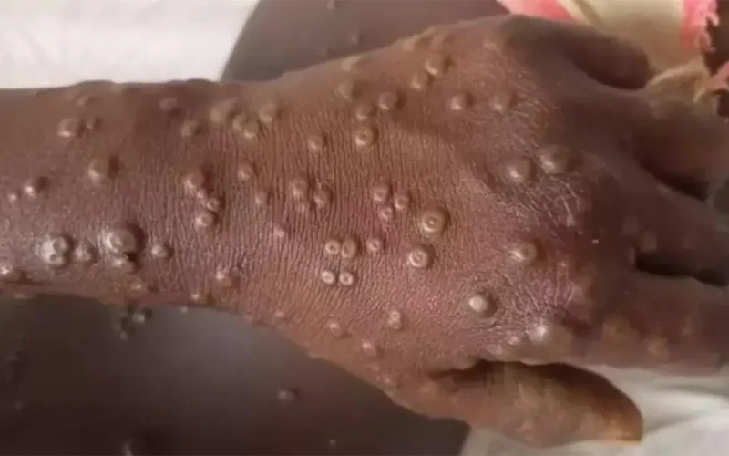 Mpox in the DRC: children are at high risk – health expert explains why