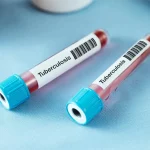 TB test