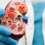 West Africans have a high risk of kidney disease – new study confirms genetic cause Kidney Disease