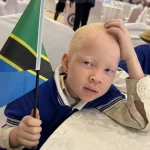 Albinism_Tanzania