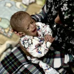 Gaza_malnutrition_baby