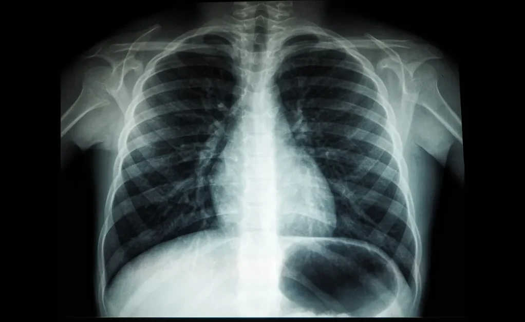 TB is curable. South Africans can’t wait around for someone else’s rescue.