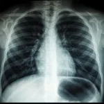 TB is curable. South Africans can’t wait around for someone else’s rescue.