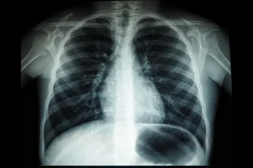 TB is curable. South Africans can’t wait around for someone else’s rescue.